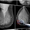 为什么大多数女性拒绝AI来解读乳房X光照片